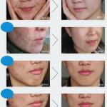 Whitening Moisturizing Skin Care Pimple Removal Cream (Pack of 1)