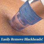 (1 piece)  Multi-Function Blackhead Whitehead Extractor Remover Sunction Device For Men and Women.