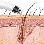 Multi-function Whitehead & Blackhead Remover Tool | Electric Device Machine |(Pack of 1).