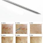 6 Pcs Stainless Steel Blackhead Whitehead  Pimple Remover